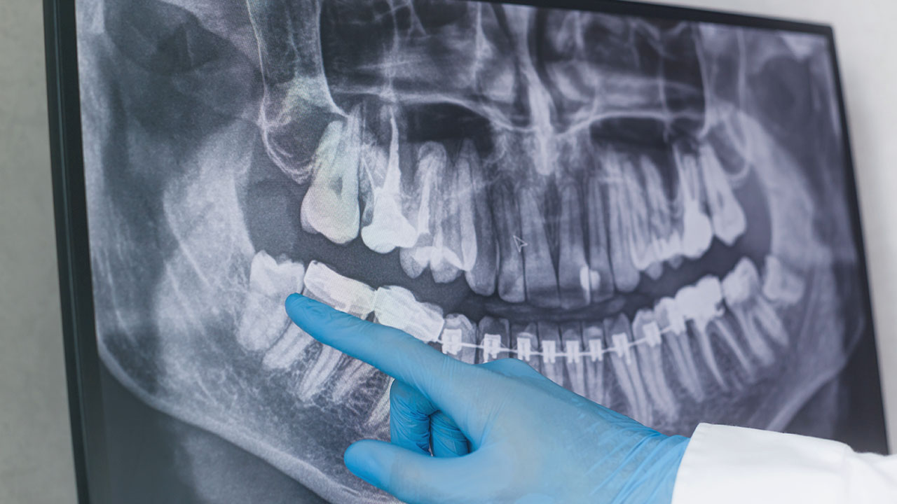 Dentes Sisos: PorquÃª e Para quÃª?