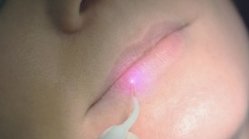 Uso de Laser para tratamento do Herpes Labial